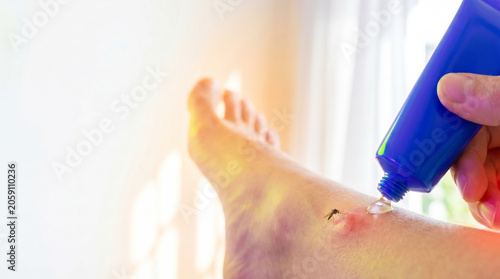 Applying ointment to itchy mosquito bite on ankle in sunlight  