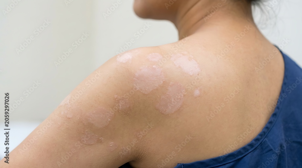 Fototapeta premium Close-up of a person's shoulder and upper back revealing multiple light, irregular skin patches, indicative of a dermatological condition or hypopi...