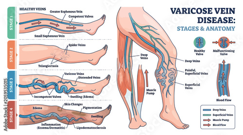 Foto Varicose vein disease stages and leg anatomy medical infographic