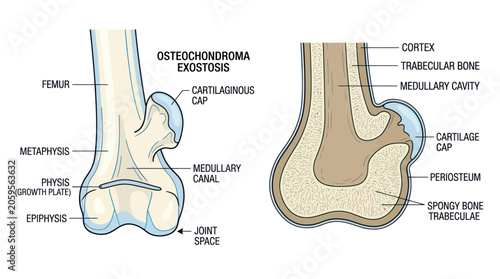 Quadro su tela Medical diagram of osteochondroma exostosis on the distal femur