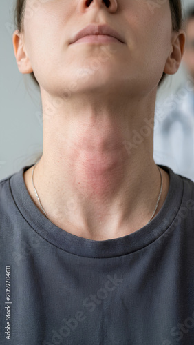 Closeup of a woman with a visible swelling in the neck area, possibly a goiter or thyroid issue