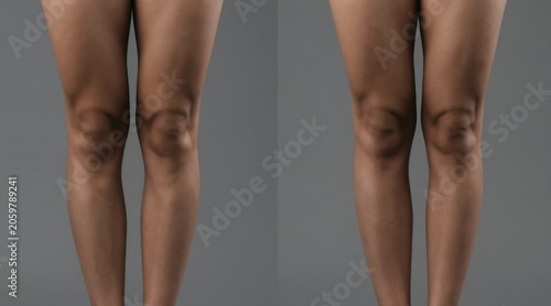 Side by side view of legs shows muscle definition before, after exercise. Before image softer shape, after image shows toned muscles. Visual comparison highlights physical transformation, fitness
