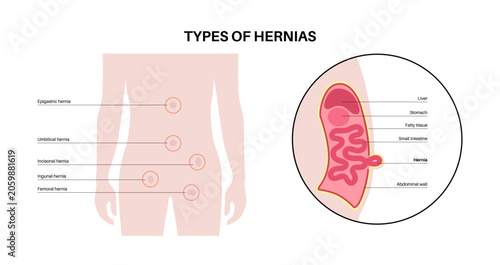Bild auf Leinwand Abdominal Hernia poster