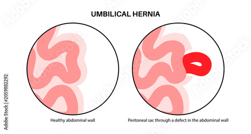 Foto Abdominal Hernia poster