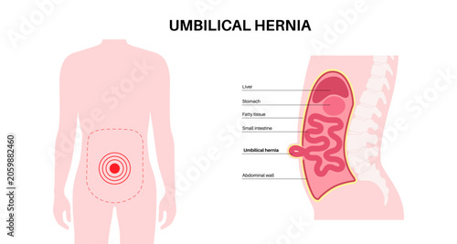 Schilderij op canvas Abdominal Hernia poster