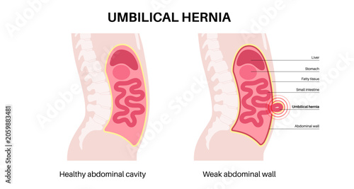Tableau sur toile Abdominal Hernia poster
