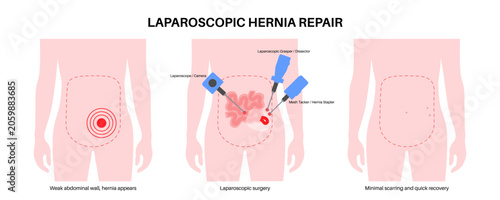 Quadro su tela Abdominal Hernia poster