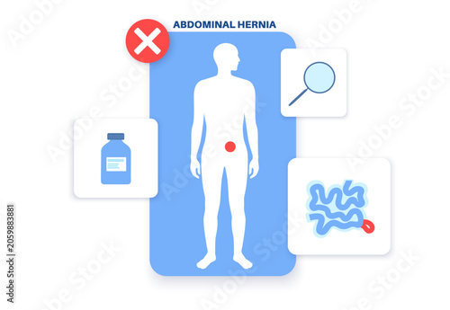 Εκτύπωση καμβά Abdominal Hernia poster