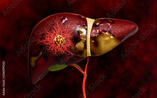 Fotografie Progression from Healthy Liver to Fatty Liver and Liver Cancer Showing Tumor Gro
