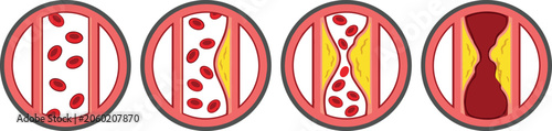 Bilde på lerret Atherosclerosis Progression Diagram Vector Set showing Stages of Artery Plaque B