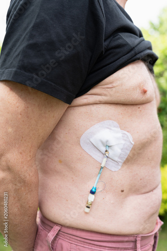 Adult patient outdoors with a medical drainage catheter attached to the abdomen, casual real-life scene about recovery, treatment and living with a medical device