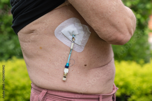 Side close-up of an adult patient lifting a shirt and showing an abdominal drainage catheter with adhesive dressing, home treatment and postoperative care concept.
