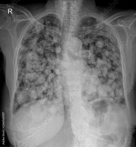 Chest X-ray Revealing Widespread Cannonball Lesions in Both Lungs