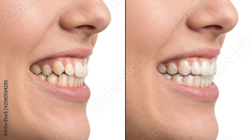 Before and after tooth whitening treatment comparison showing smile transformation result