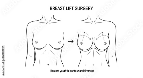 Foto Line art illustration showing a before and after breast lift surgery concept, demonstrating how to restore youthful contour and firmness