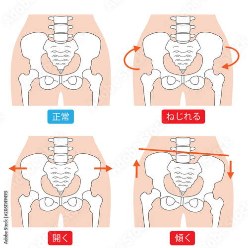 正常な骨盤と歪んだ骨盤のタイプ