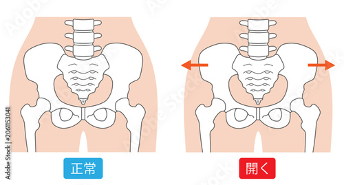 正常な骨盤と開いた骨盤
