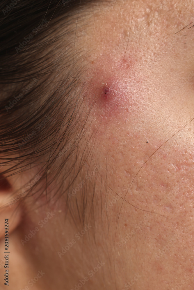 Fototapeta premium Extreme close up of inflamed acne pimple with irritated skin, deep pores and skin texture on woman face.