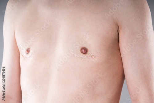 Male torso with surgical scars after gynecomastia, breast reduction or FTM top surgery, medical and transgender healthcare concept