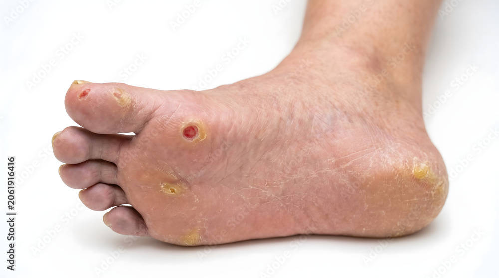 Fototapeta premium Diabetic foot ulcer and skin complications close-up. Chronic wound, neuropathy or peripheral artery disease medical concept. Isolated on white. AI generated.