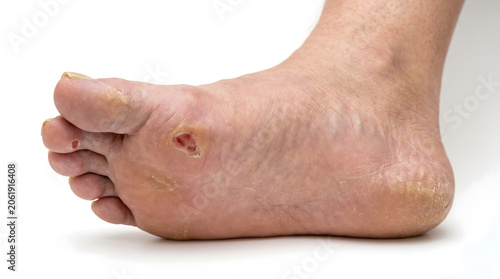 Diabetic foot ulcer and skin complications close-up. Chronic wound, neuropathy or peripheral artery disease medical concept. Isolated on white. AI generated.