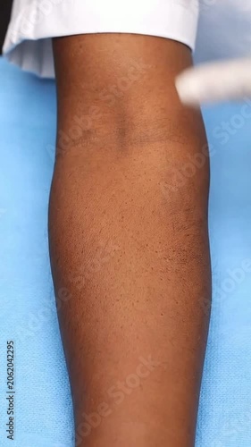Close-Up Examination of Skin Texture on Human Forearm by Healthcare Professional in Clinical Setting Highlighting Dermatological Assessment