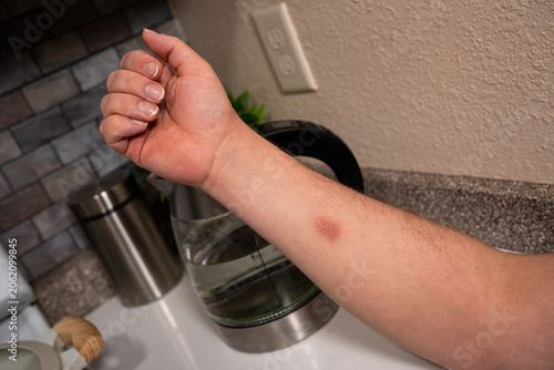 Healing burn on forearm near electric kitchen kettle, close view of a household skin injury while using a hot kitchen appliance