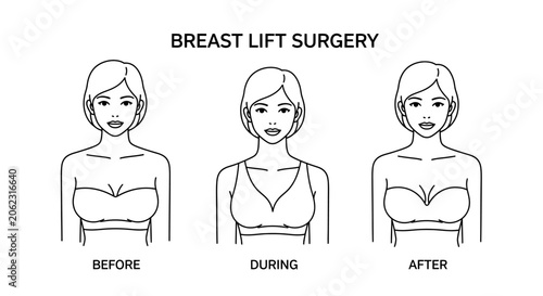 Schilderij op canvas Line art illustration showing stages of breast lift surgery: before, during, and after, illustrating aesthetic procedure results