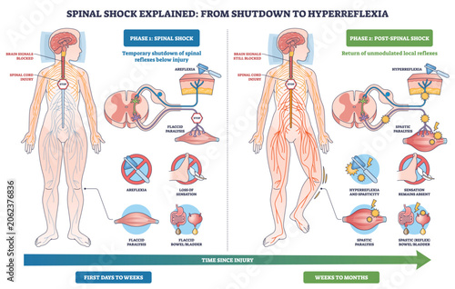 Tableau sur toile Spinal shock from shutdown to hyperreflexia shows recovery of reflexes after SCI, nervous system figure, spinal cord, and reflex hammer mark shift from areflexia to spasticity