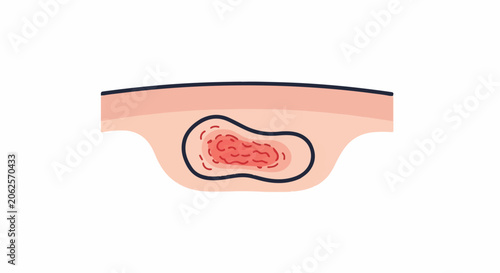 Stylized illustration of inflamed skin layer with a lesion