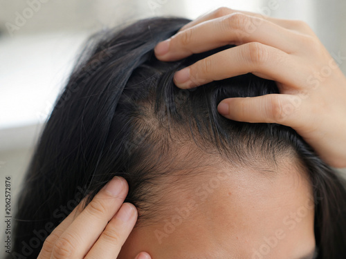 Young Asian woman checking her scalp and hairline for hair loss