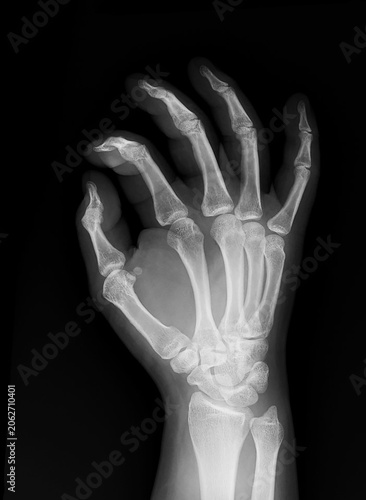 X-ray of human hand and wrist on black background, anteroposterior (OBLIQUE) view .