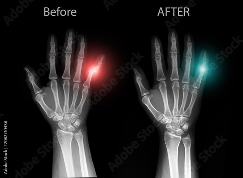 X-ray of human hand showing dislocation of the little finger (fifth finger), AP view on black background. Medical radiograph of bones, joints, metacarpals and phalanges for radiology.