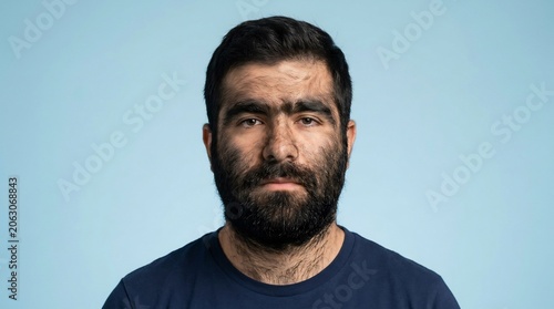 Studio portrait of an adult man with hypertrichosis exhibiting excessive facial hair against a light blue background