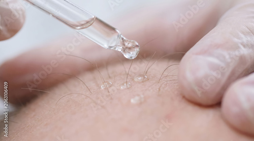 Baldness treatment scalp serum dropper glove hair care clinic skin closeup applying clear liquid for calm dermatology procedure