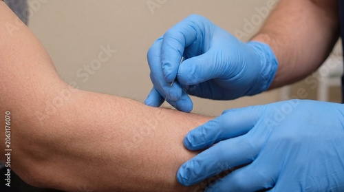 Therapist performing dry needling on patient's forearm