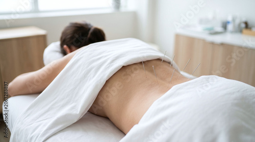 A young Caucasian woman lies on a treatment table with acupuncture needles inserted in her back. The room is bright and minimalistic, promoting relaxation.
