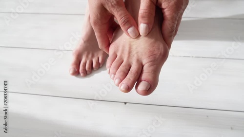 Female foot suffers from inflammation of the big toe bone. Hallux valgus, bunion in foot on white background. Close up. 