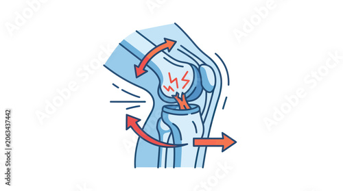 Quadro su tela Knee joint pain illustration with red arrows showing movement and injury