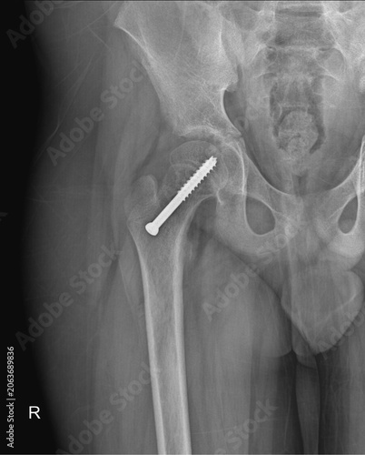 Postoperative AP X-ray of Right Hip with Cannulated Screw Fixation of Femoral Neck Fracture
