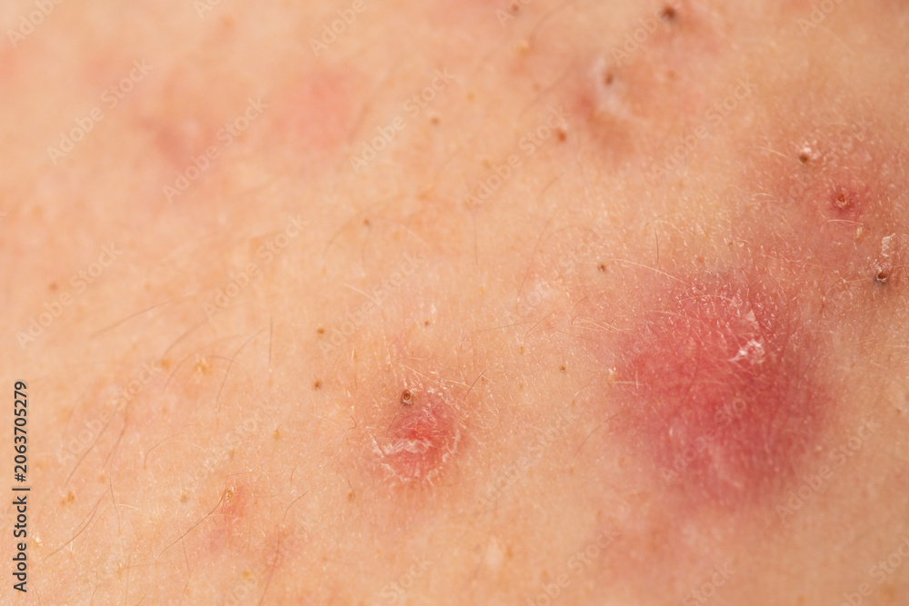 Fototapeta premium Dermatology concept with acne skin pores. Skin rash texture with acne. Inflamed skin bumps acne macro. Irritated acne skin.