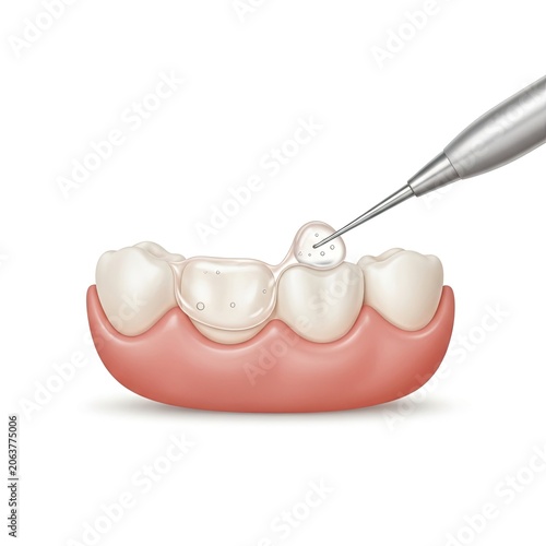 Dental sealant application on teeth for cavity prevention.