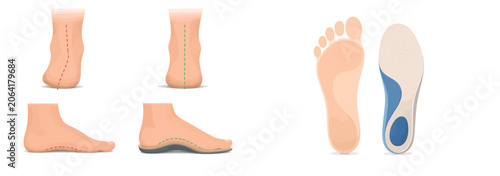Obraz na płótnie Vsai feet correcting flat foot pronation with orthopedic insoles