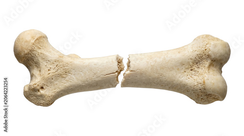 Foto Broken human femur bone realistic medical anatomy specimen isolated on transparent background science