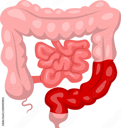 Valokuva Bowel Surgery high anterior resection