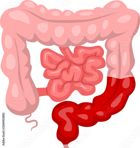 Slika na platnu Bowel Surgery low anterior resection