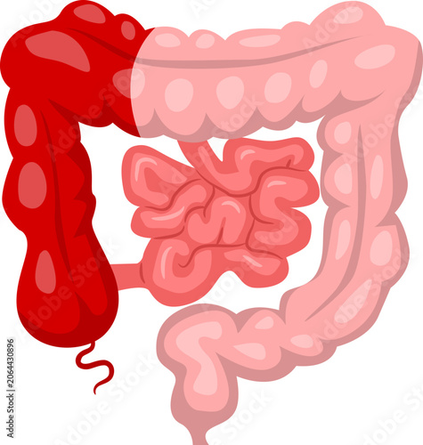 Foto Bowel Surgery right hemicolectomy