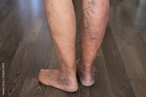 Patient showing severe varicose veins on legs