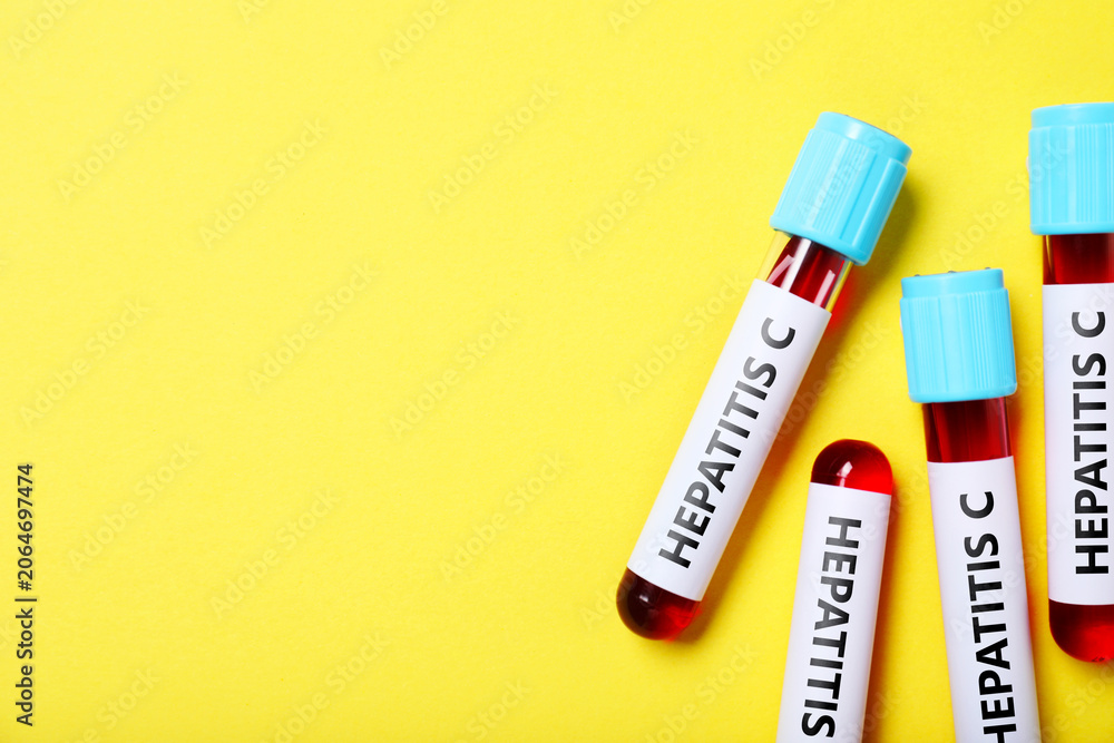 Obraz premium Hepatitis C test. Tubes with blood and labels on yellow background, top view