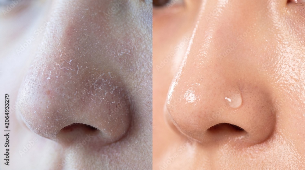 Fototapeta premium Dry nose flaky skin hydration smooth texture healthy skincare close up transformation before and after facial care moisture improvement